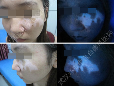 18岁女孩盲目吃药,白斑困扰11年