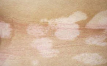 治疗白癜风要多少钱