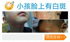 幼儿白斑病症的外部症状表现是什么