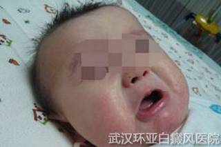 儿童白癜风的早期症状有哪些