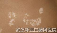 白癜风的发病病因是什么