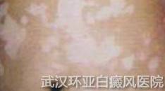 哪些人群容易患上白癜风