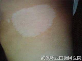 白癜风患者饮食调整怎么做