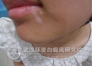 患上白癜风主要有哪些症状