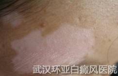 青少年白癜风怎么才能治好疾病