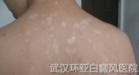 成人患了白癜风怎么治疗