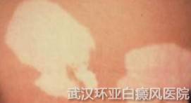 使用白癜风遮盖液的方法好吗