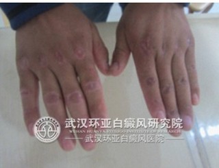 如何诊断是否患上了白癜风