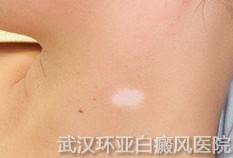 白癜风的初期有哪些症状