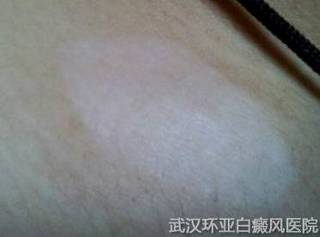 预防白癜风从饮食方面做起