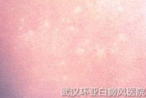 白癜风患者心态如何调整