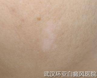 白癜风诊断有哪些要点