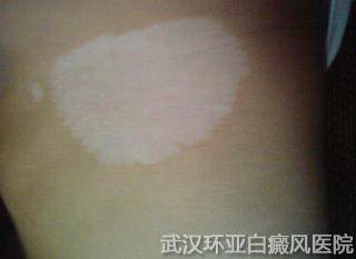 白癜风治疗方法哪些是可行的