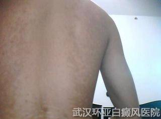 怎么治疗白癜风会更有效