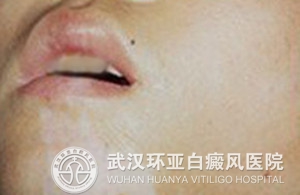 治疗女性白癜风有哪些基本原则