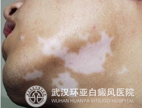 白癜风会有哪些危害