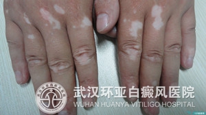 白癜风日常护理工作要注意什么