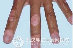 白癜风在平时的护理要注意什么