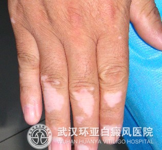 使用白癜风偏方要注意什么