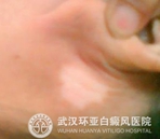 预防白癜风的方法都有哪些