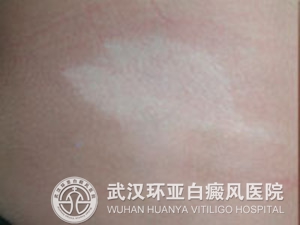 治疗白癜风患者心理问题有哪几招