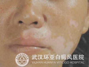 青少年患上白癜风的原因有哪些