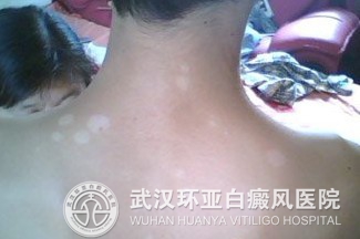 白癜风的出现会产生哪些危害