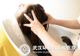 女性患上了白癜风有哪些要注意的