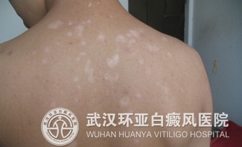 诊断白癜风有哪些注意事项