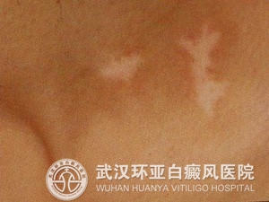 白癜风的出现会带来哪些危害