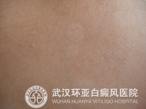 白癜风的病因有哪些