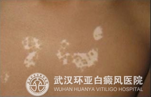 白癜风日常治疗方法有哪些