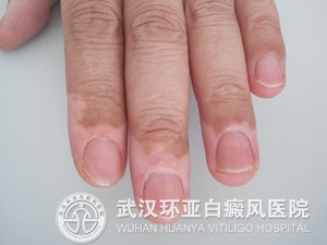 白癜风怎样正确吃水果