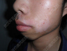 男性白癜风患者如何健康养生