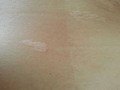 白癜风患者应该如何养生