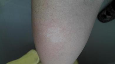 得了白癜风有什么症状