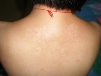 儿童白癜风如何治疗