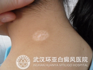 白癜风患者的养身有哪些