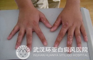 小儿额头上长白斑是得了白癜风吗