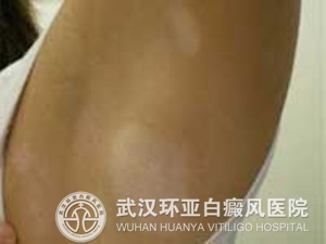 武汉白癜风医院