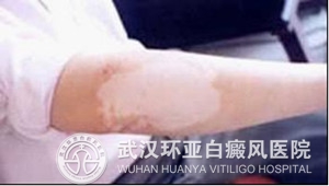平时白癜风患者吃什么好