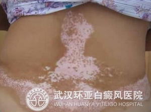 白癜风发病会对患者造成哪些伤害