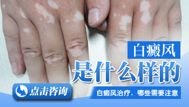白癜风患者常见的症状有哪些呢