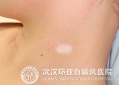 白癜风如何治疗有效果