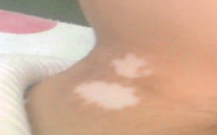 白癜风与内分泌有无关系