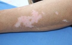 白癜风的病因是什么