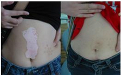 白癜风患者运动时有什么讲究呢