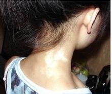 如何避免青少年诱发白癜风呢?