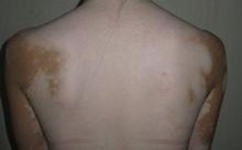 生活方式对白癜风的影响是什么