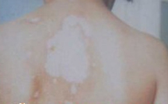 白癜风发病后是否会扩散到全身